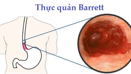 vì sao trào ngược dạ dày gây khó thở