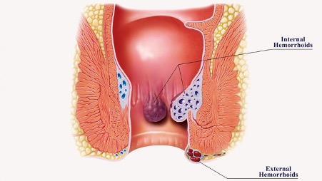 dấu hiệu nhận biết bị trĩ