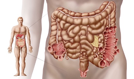 biến chứng của viêm túi thừa đại tràng